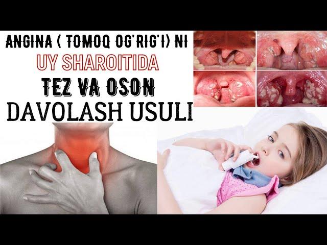 Angina (tomoq og'rig'i)ni davolash usullari, kelib chiqish sabablari va oldini olish yo'llari