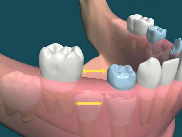 Dental Video of Early Loss of primary Teeth