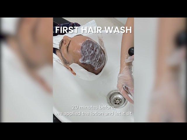 Post-operative washing guide after Hair Transplant with Dr. Can Aesthetic