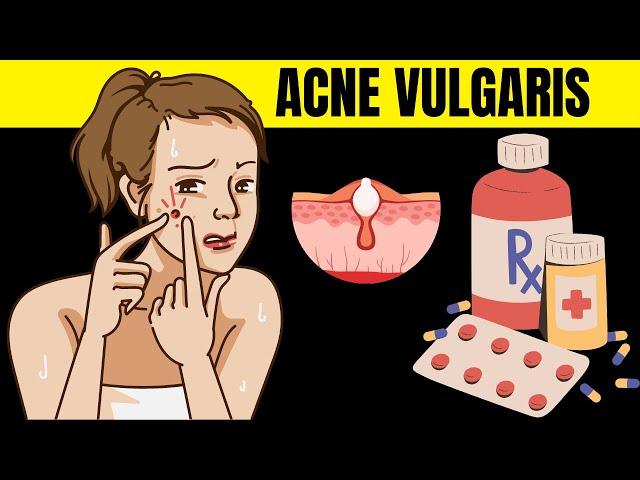 Acne Vulgaris - Causes, Risk Factors, Signs And Symptoms, And Various Treatment Options