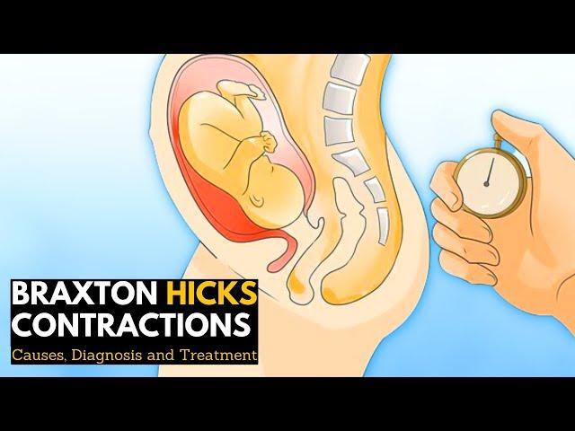 Braxton Hicks contractions, Causes, Signs and Symptoms, Diagnosis and Treatment.