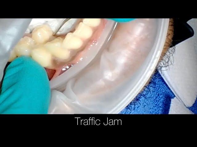 Supernumerary Tooth Causing a Traffic Jam. Step by Step Dental Extraction