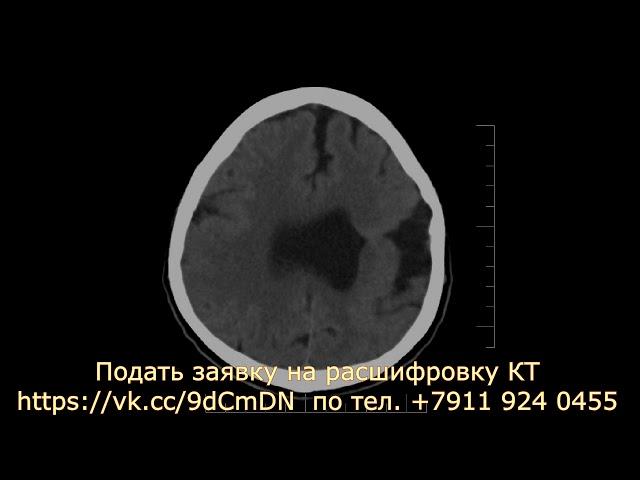 Дисциркуляторная энцефалопатия на расшифровке КТ мозга с диска в формате DICOM