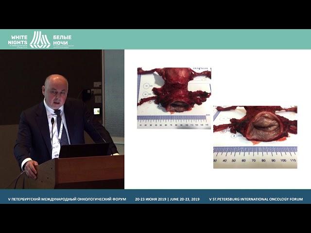 Practice of laparoscopic surgery for cervical cancer: Petrov center of oncology (Igor Berlev)