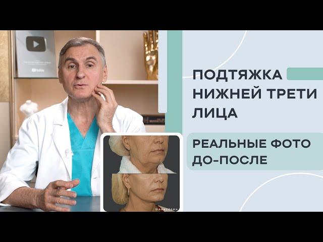 ПОДТЯЖКА НИЖНЕЙ ТРЕТИ ЛИЦА  8 СПОСОБОВ