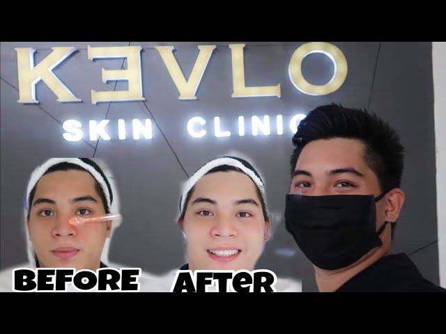 KEVLO SKIN CLINIC ORMOC | THE BEST SKIN CLINIC | BEST FACIAL IN ORMOC