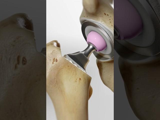 Total hip replacement explained (3D Animation)