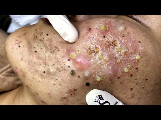 Big Cystic Acne Blackheads Extraction Blackheads & Milia, Whiteheads Removal Pimple Popping # 1576