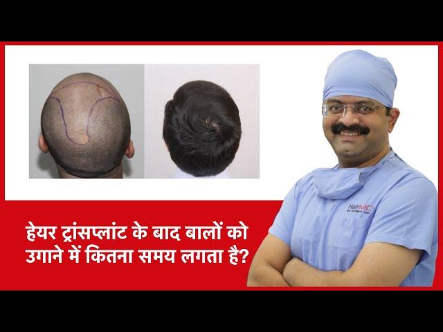 How Long It Takes For Hair To Grow After Hair Transplant | HairMD, Pune | (In HINDI)