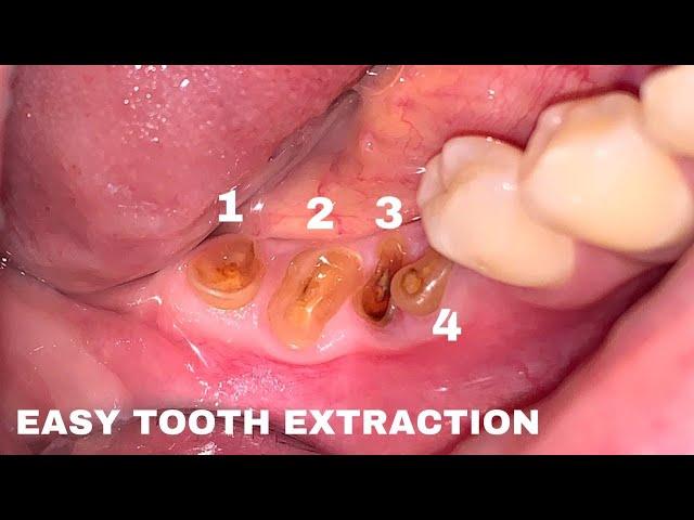 Very Satisfying Tooth Extraction | Dokter Gigi Tri Putra