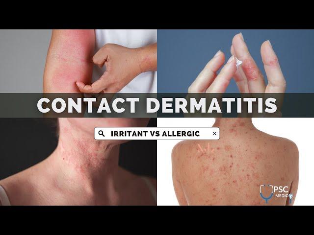 Irritant Contact Dermatitis vs Allergic Contact Dermatitis | Dermatology | UPSC MEDICO