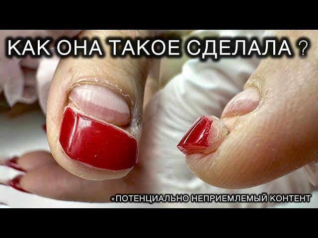 ИСТОРИЯ ОДНОГО (ИЛИ ВСЕ ТАКИ ДВУХ) НОГТЕЙ #подолог #подология #обучениеподологии