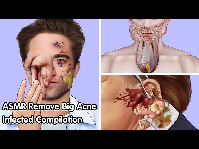 ASMR Remove Big Acne Infected Eyes Compilation - Deep Cleaning Animation