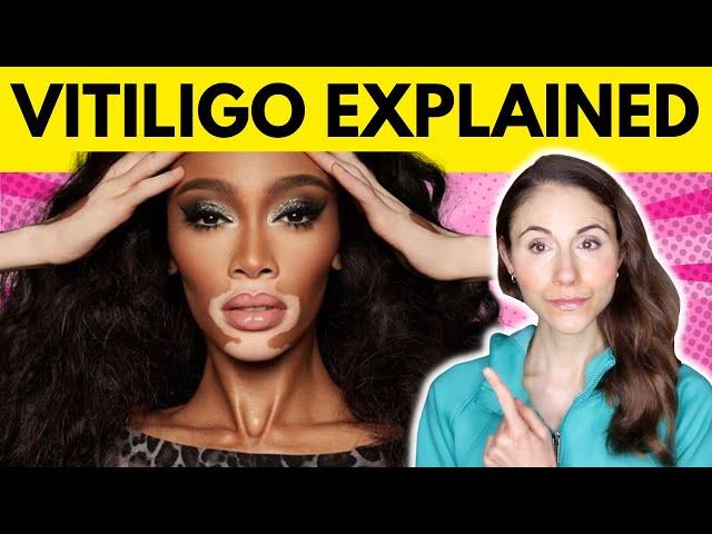 Vitiligo: WHY YOU HAVE IT & WHAT TO AVOID