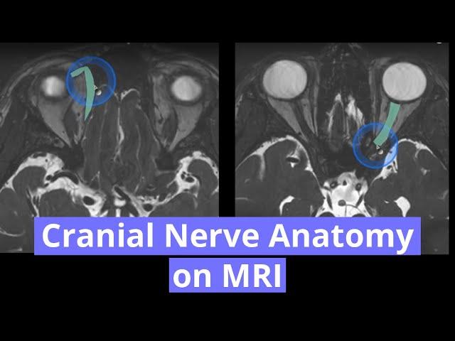 Cranial Nerve Anatomy on MRI