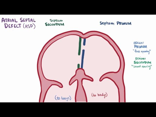 Atrial septal defect ASD repair, causes, types, symptoms & pathology