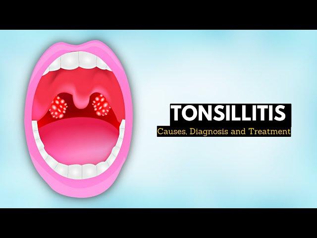 Tonsillitis, Causes, Signs and Symptoms, Diagnosis and Treatment.