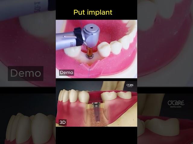 How is dental implant?