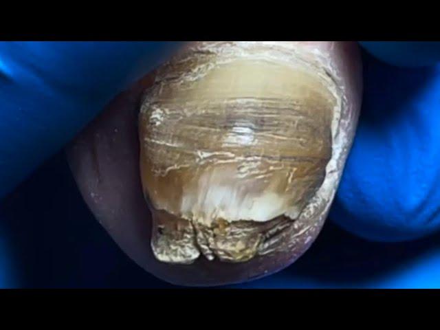 Thick Onychomycosis, Abnormal Growth Of Black Mud【Pedicure Master Lin Jun】