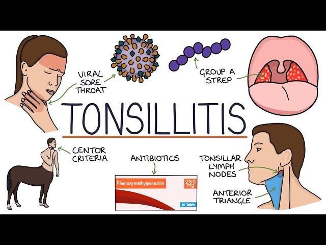 Understanding Tonsillitis