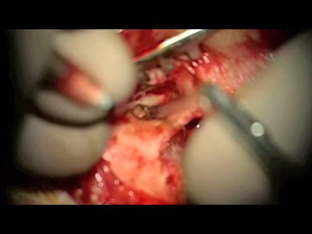 Left Cartilage Tympanoplasty_Dr Nirmal Patel