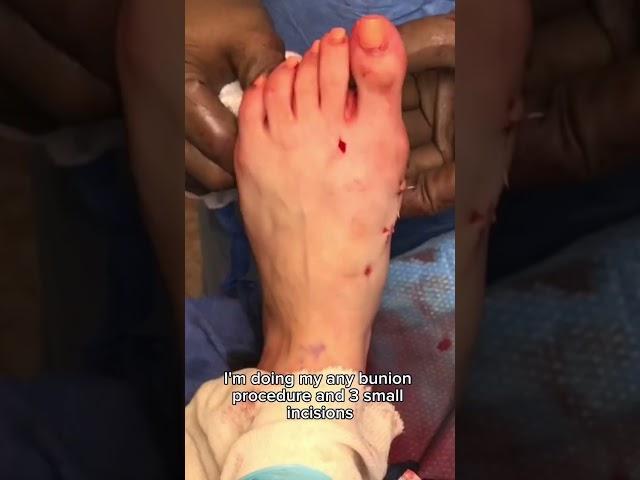 How to Fix Bunions in 30 Seconds
