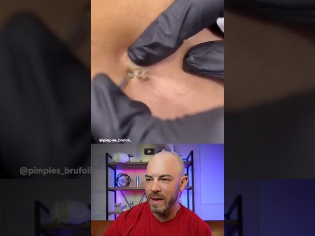 10/10 pimple pop technique here! #pimplepop #dermreacts #doctorreacts