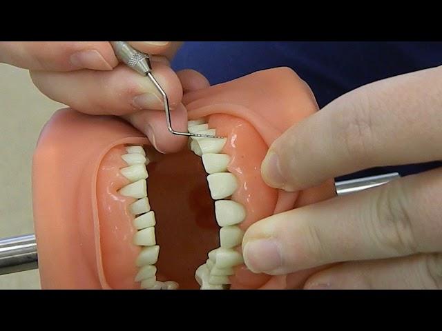 Periodontal Probe Technique