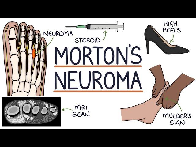 Morton’s Neuroma