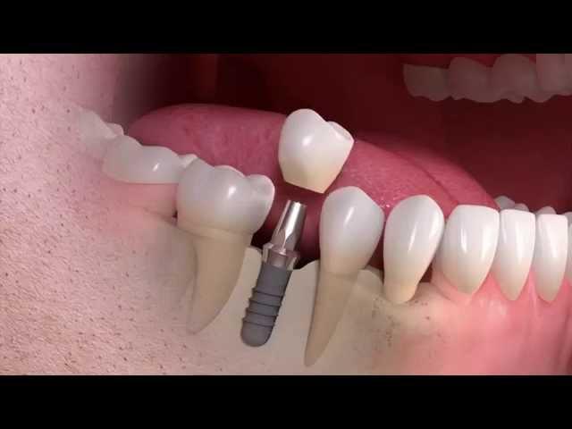 Straumann - Implant-borne single-tooth treatment