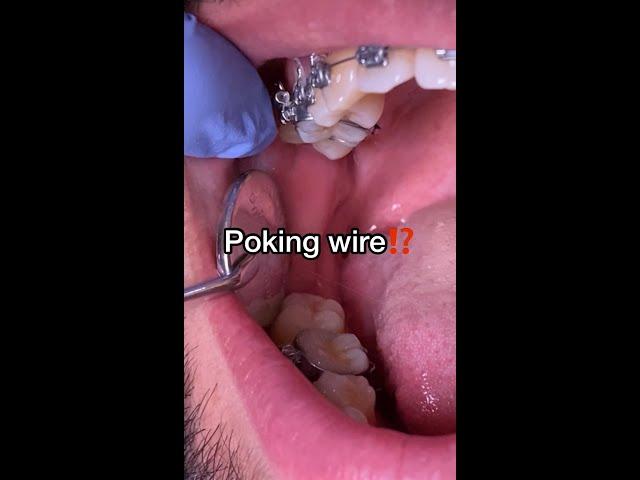 What to do if you have a Poking Wire - Braces Emergency - Tooth Time Family Dentistry New Braunfels