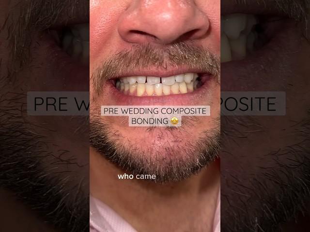 Pre wedding composite bonding by Dr. Kunal  #ruhdental