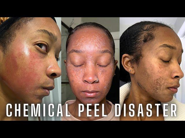 Chemical Peel Nightmare! Full Peeling Process. Before, During, and After. NEVER AGAIN