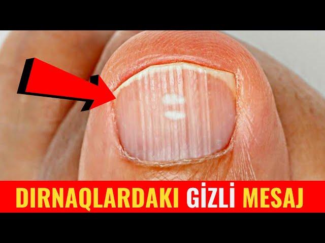 DİQQƏT! Dırnaqlarınız Xəstəliklərdən Xəbər Verir! - Bu Əlamətlər Varsa...