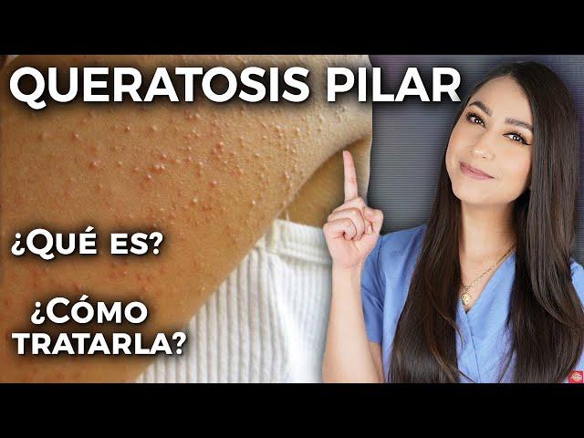 Keratosis Pilaris l What is it and how to treat it?