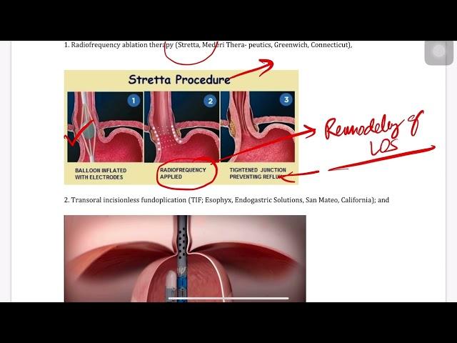 GERD , STRETTA/LINX/MUSE ,FUNDOPLICATION