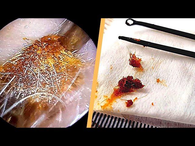 Hair Ball Stuck in Ear Extracted with Probes and Suction