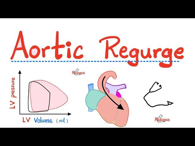 Aortic Regurgitation (AR) - Aortic Insufficiency - Valvular Heart Disease (VHD) - Cardiology