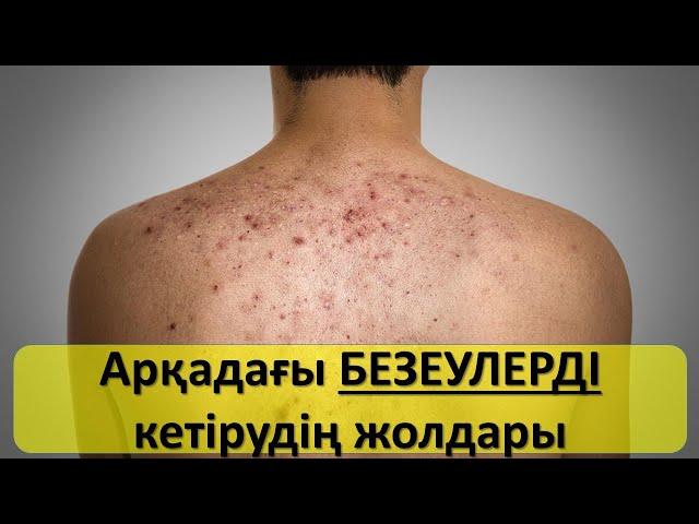 Арқадағы безеуді қалай кетіруге болады?