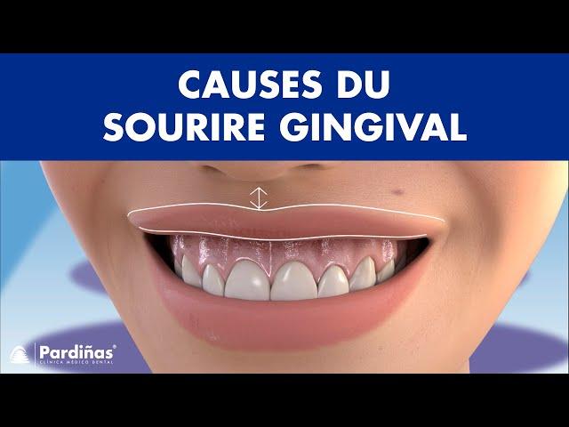 Causes du SOURIRE GINGIVAL - Montrez-vous beaucoup de GENCIVES lorsque vous SOURIEZ ? ©