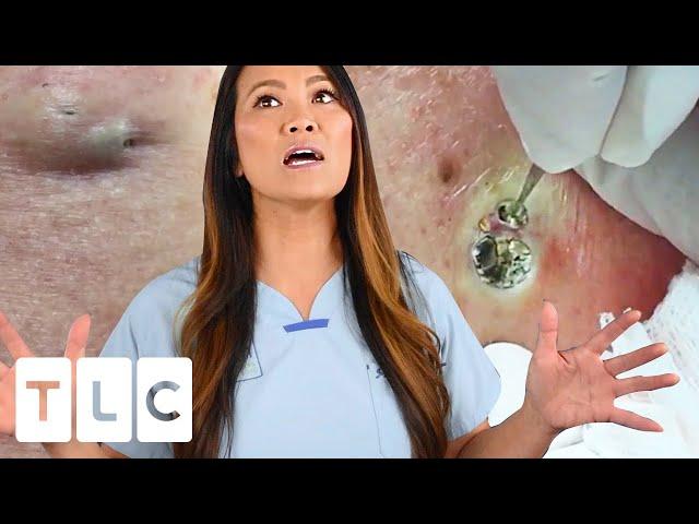 "The Award For The Biggest Blackhead" & A Juicy Cyst | Dr. Pimple Popper: This is Zit