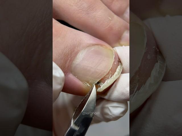 Система препаратного педикюра 10|11 #nails #podologia #ногти #pedicure #педикюр #подолог