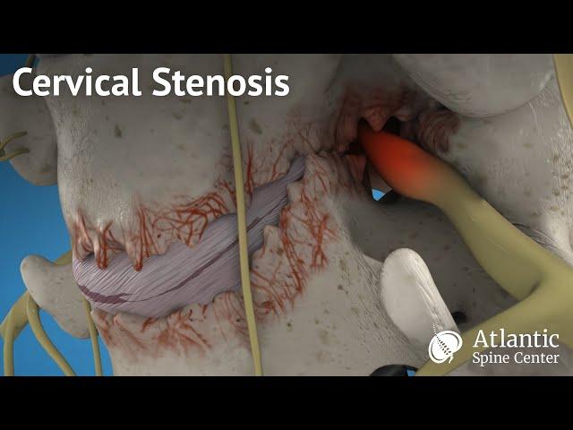 Cervical stenosis