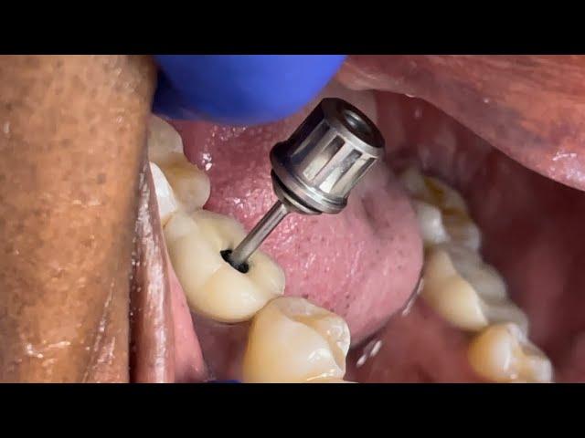 Wiggly Wiggly Dental Implant