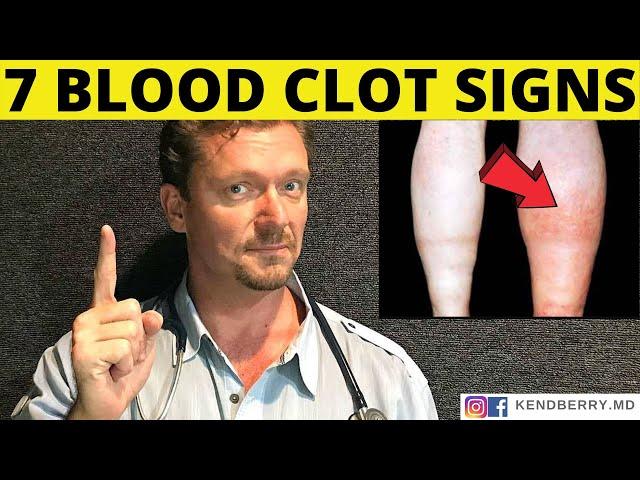 7 Warning Signs of a BLOOD CLOT (Symptoms) 2024