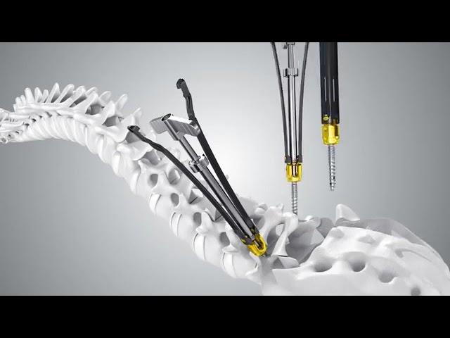 Sanyou Medical: Zita MIS Bone Cement Screw system