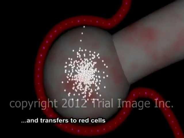 Pulmonary Edema - Negative Pressure video by Dr. Cal Shipley, M.D.