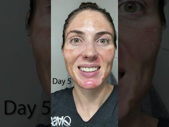 20% TCA Chemical Peel - Wait until the end!  Results before your eyes. Melasma & acne scar treatment