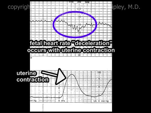 Umbilical Cord Prolapse and Hypoxic Ischemic Encephalopathy Cal Shipley, M.D.