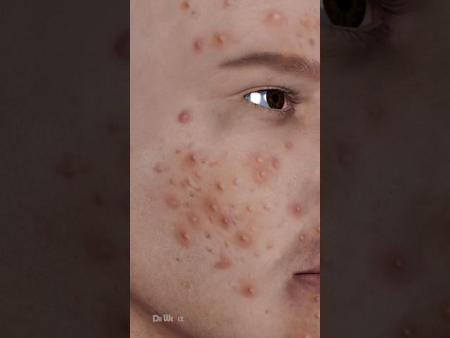 What Exactly Is Acne, Causes of Acne: 3D Animation